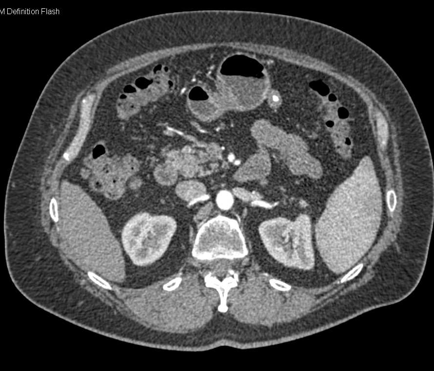 1cm Gastric GIST Tumor with Calcification - CTisus CT Scan