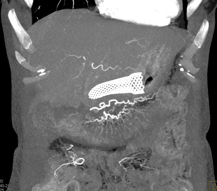 Infiltrating Gastric Adenocarcinoma Excludes Down to the Transverse Colon - CTisus CT Scan
