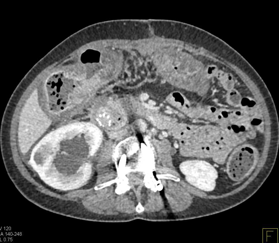 Infiltrating Gastric Adenocarcinoma Excludes Down to the Transverse Colon - CTisus CT Scan
