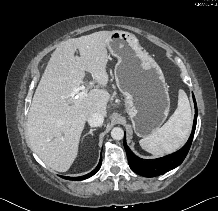 Gastric Adenocarcinoma - CTisus CT Scan