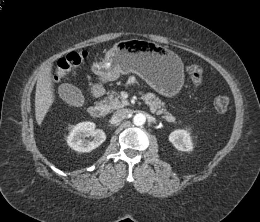 Carcinoma Gastric Antrum - CTisus CT Scan