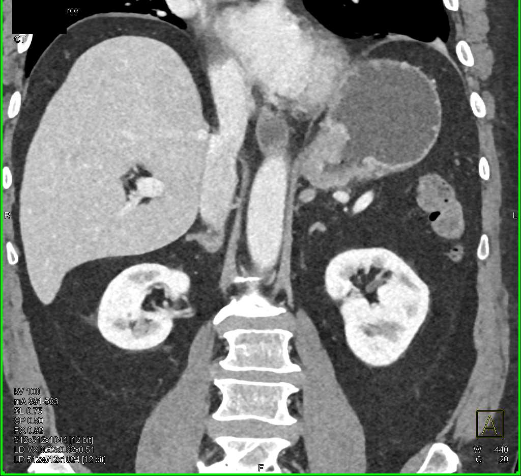 Infiltrating Gastric Cancer - CTisus CT Scan