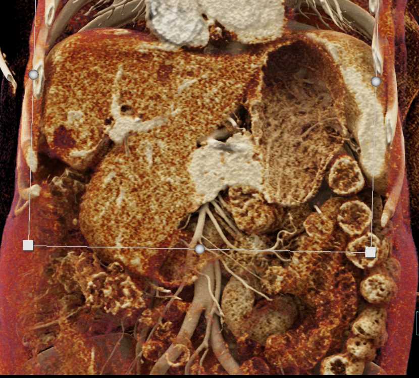 Carcinoma of the Gastric Antrum with Cinematic Rendering - CTisus CT Scan