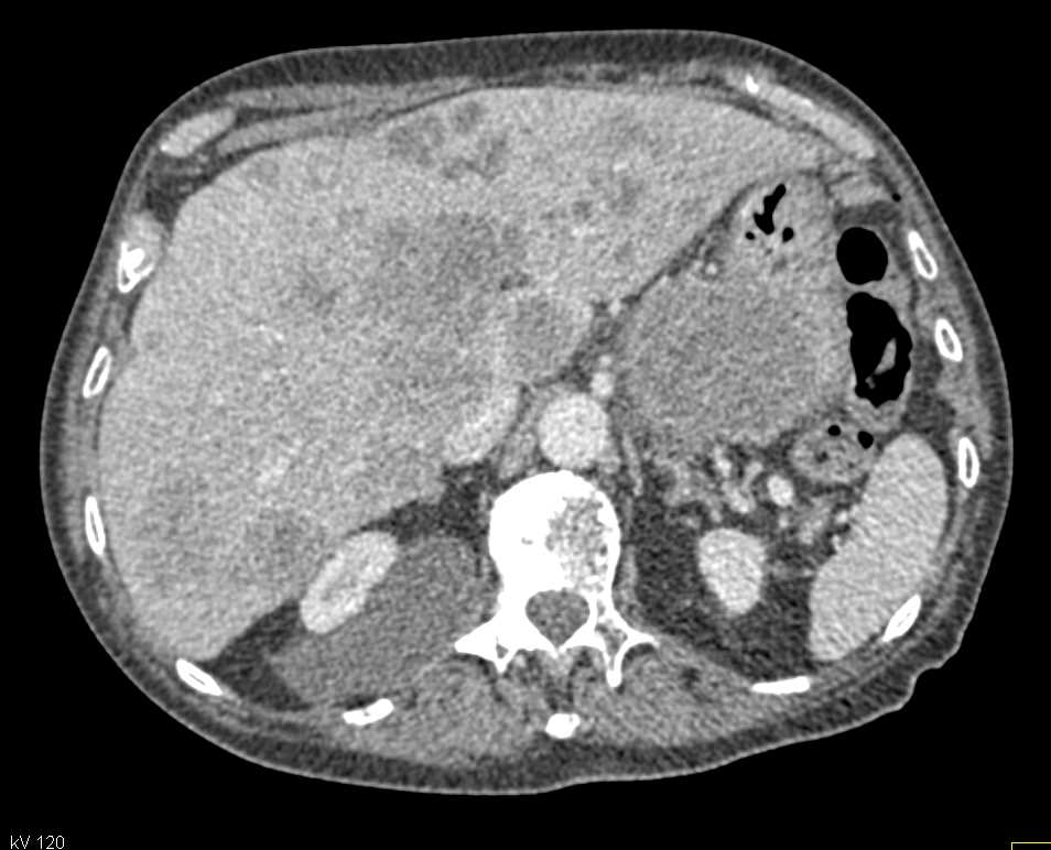 Gastric GIST Tumor with Liver and Bone Metastases - CTisus CT Scan
