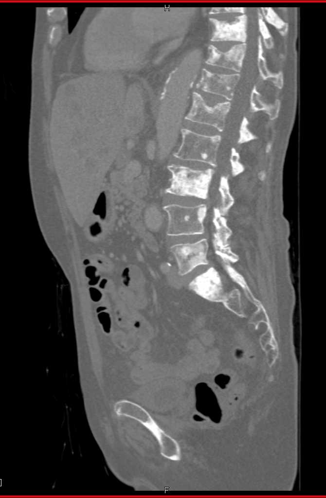 Gastric GIST Tumor with Liver and Bone Metastases - CTisus CT Scan