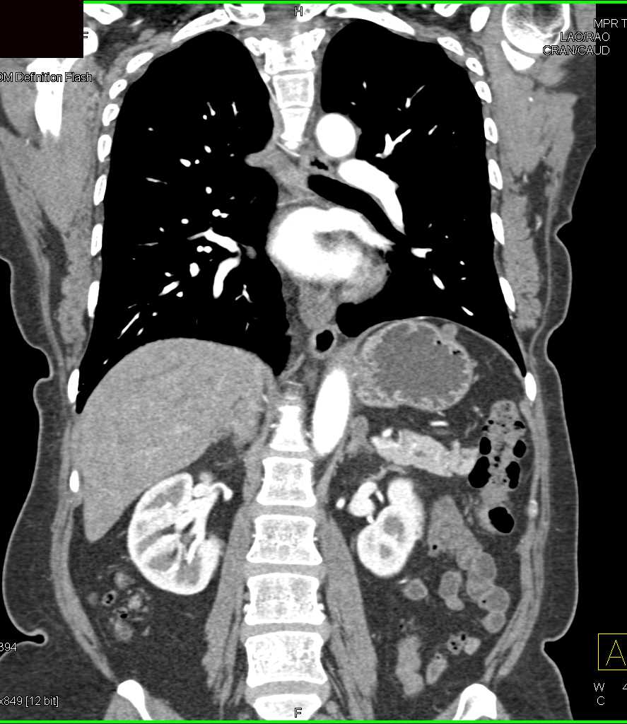 1cm GIST Stomach - CTisus CT Scan