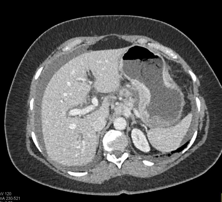 Gastric Adenocarcinoma with Adenopathy and Carcinomatosis - CTisus CT Scan