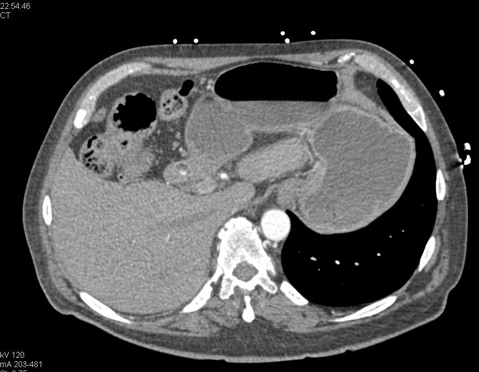 Carcinoma Gastric Antrum with Active Bleed - CTisus CT Scan