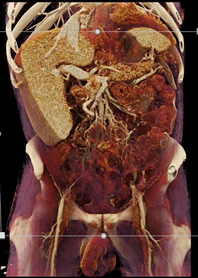 Gastric Adenocarcinoma - CTisus CT Scan