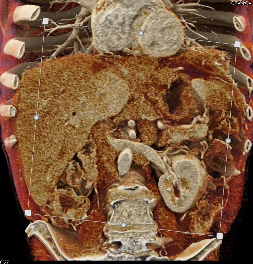 Gastric Adenocarcinoma - CTisus CT Scan