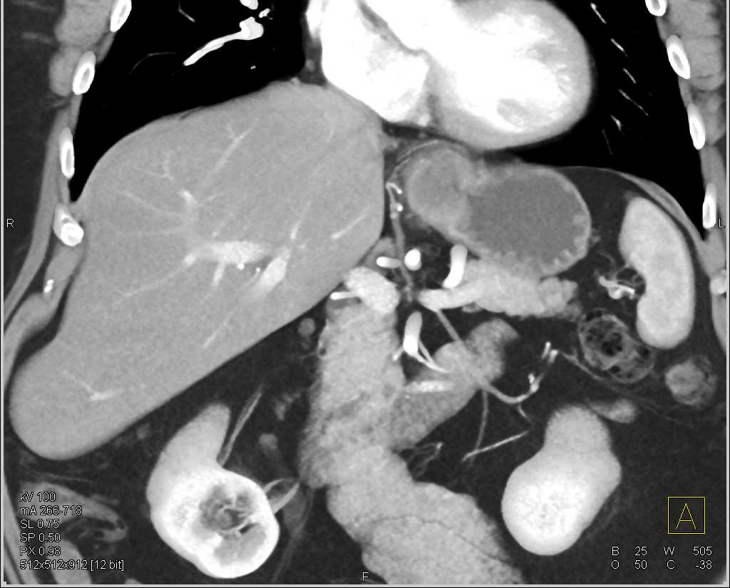 Carcinoma in Gastric Fundus - CTisus CT Scan