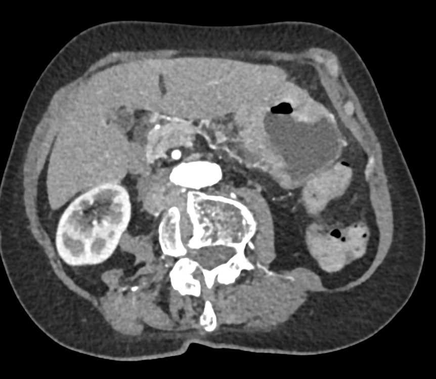 Ulcerating Gastric Adenocarcinoma with Bulky Adenopathy - CTisus CT Scan
