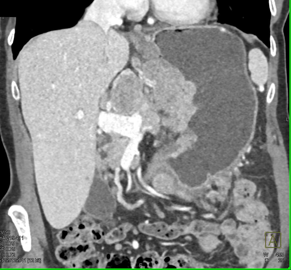 Ulcerating Gastric Adenocarcinoma with Bulky Adenopathy - CTisus CT Scan