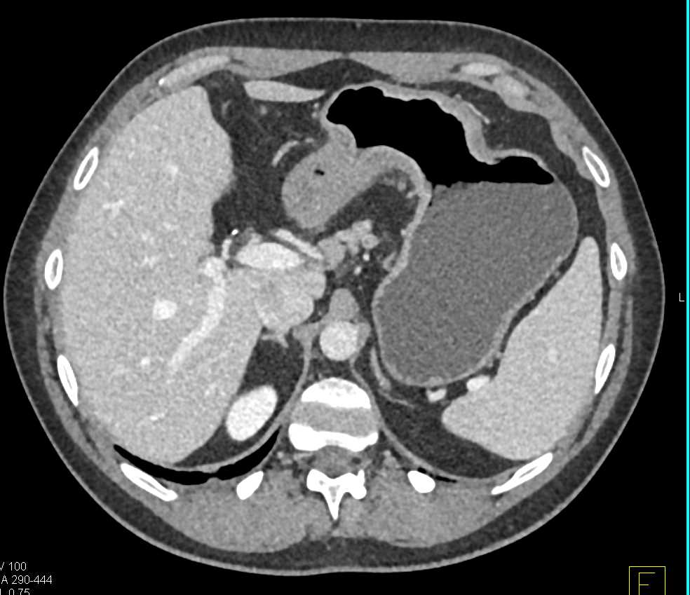 Carcinoma of the Gastric Antrum - CTisus CT Scan