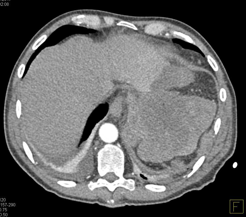 Ulcerating Gastric GIST Tumor - CTisus CT Scan