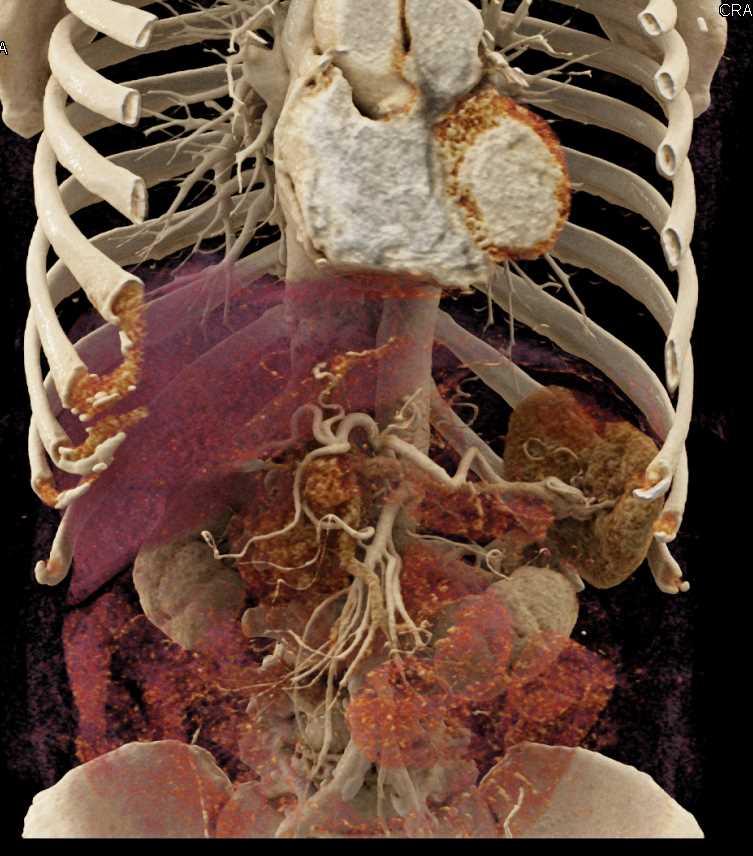 Cinematic Rendering (CR) Mapping of the Stomach - CTisus CT Scan