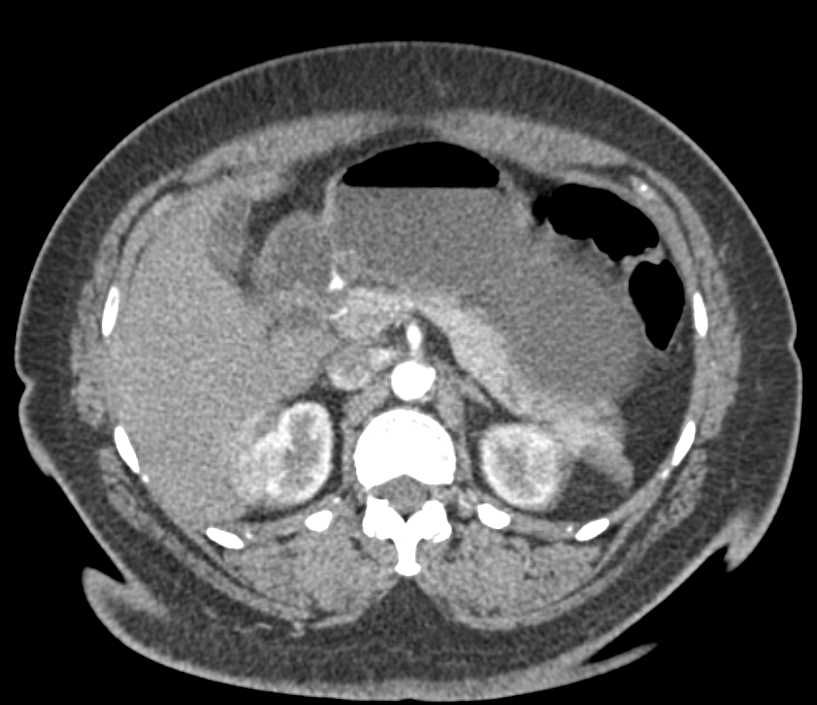 Bleeding Polyp in the Gastric Antrum - CTisus CT Scan