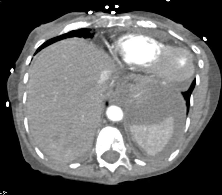 Gastric Cancer with Perforation - CTisus CT Scan