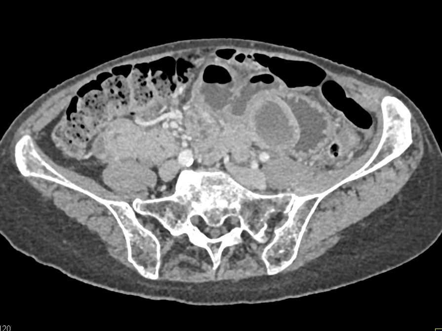 Exophytic Gastric GIST Tumor - CTisus CT Scan