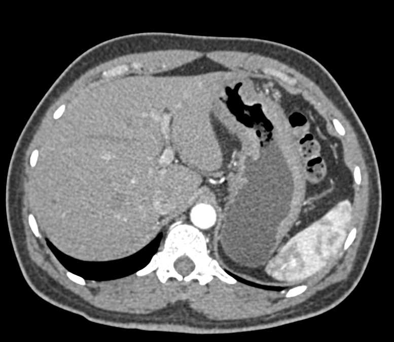Gastric Adenocarcinoma in Body and Antrum - CTisus CT Scan