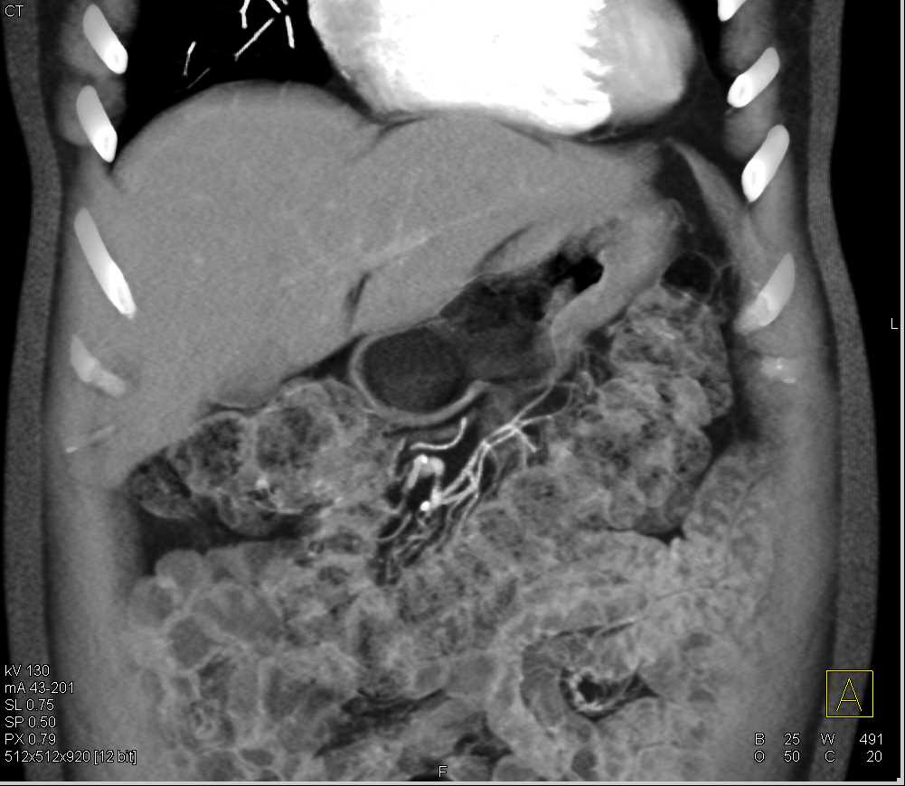 Gastric Adenocarcinoma in Body and Antrum - CTisus CT Scan