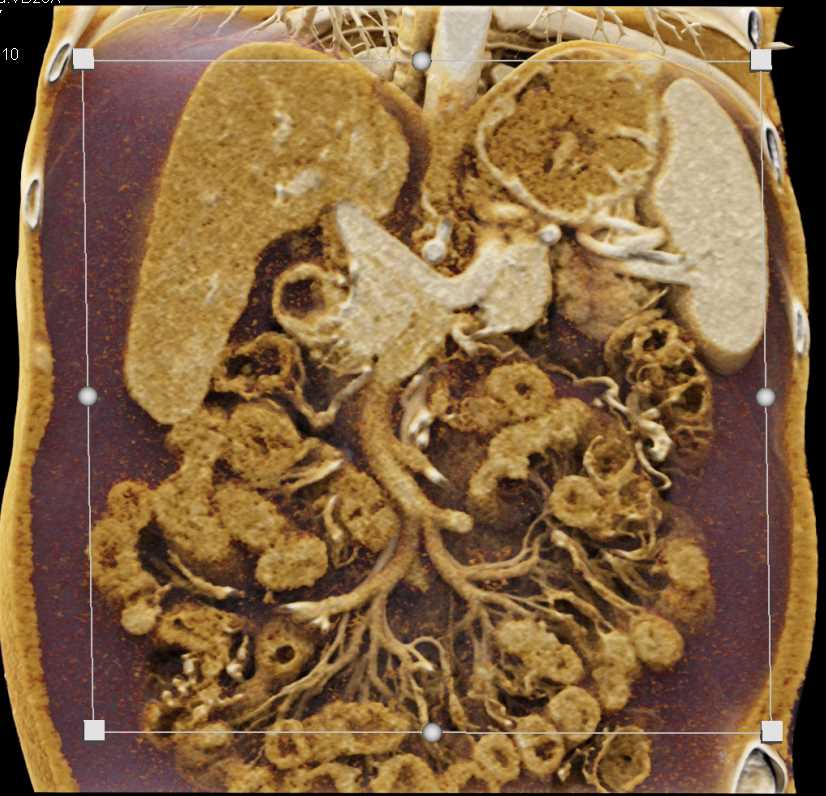 Gastric Varices and Large Collaterals with Cinematic Rendering - CTisus CT Scan