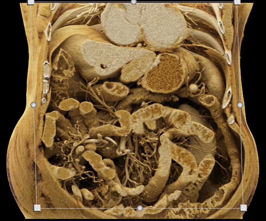 Gastric GIST Tumor - CTisus CT Scan