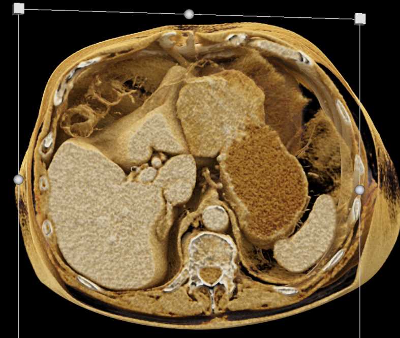 Gastric GIST Tumor - CTisus CT Scan