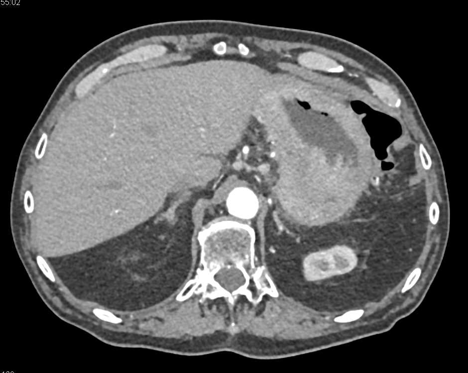 Infiltrating Gastric Adenocarcinoma - CTisus CT Scan