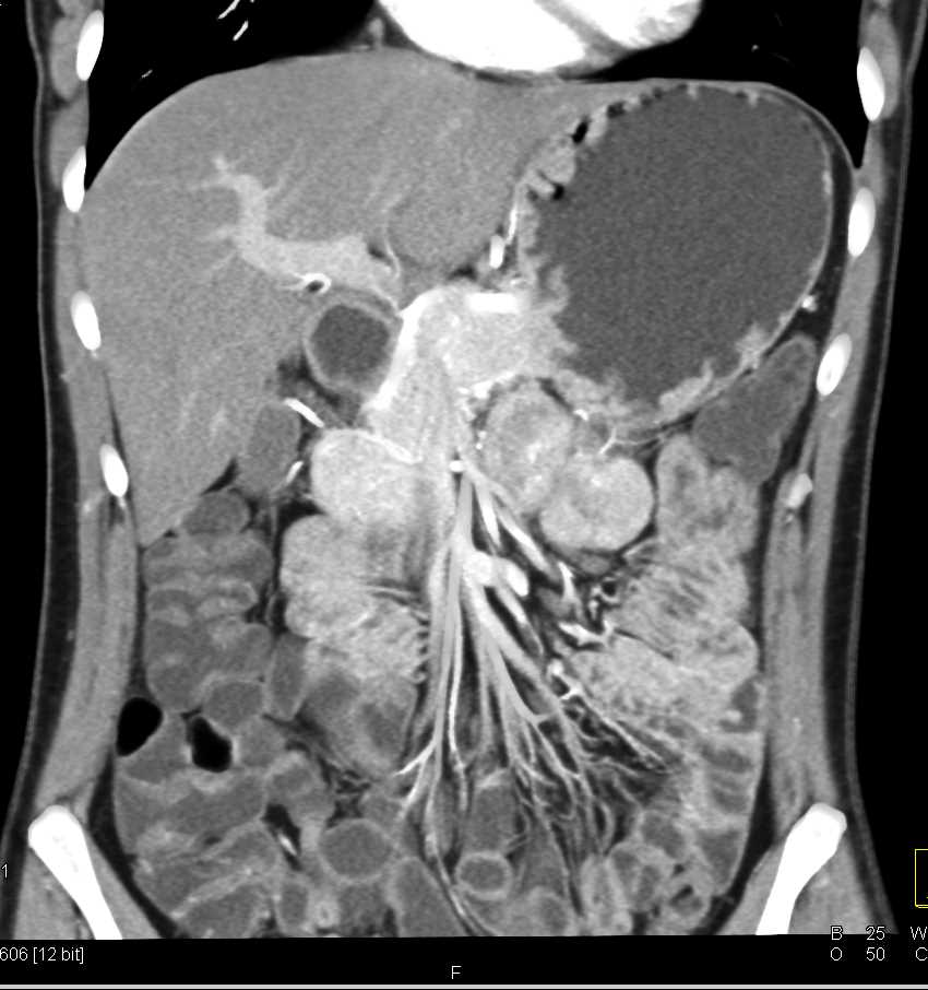 Gastritis - CTisus CT Scan