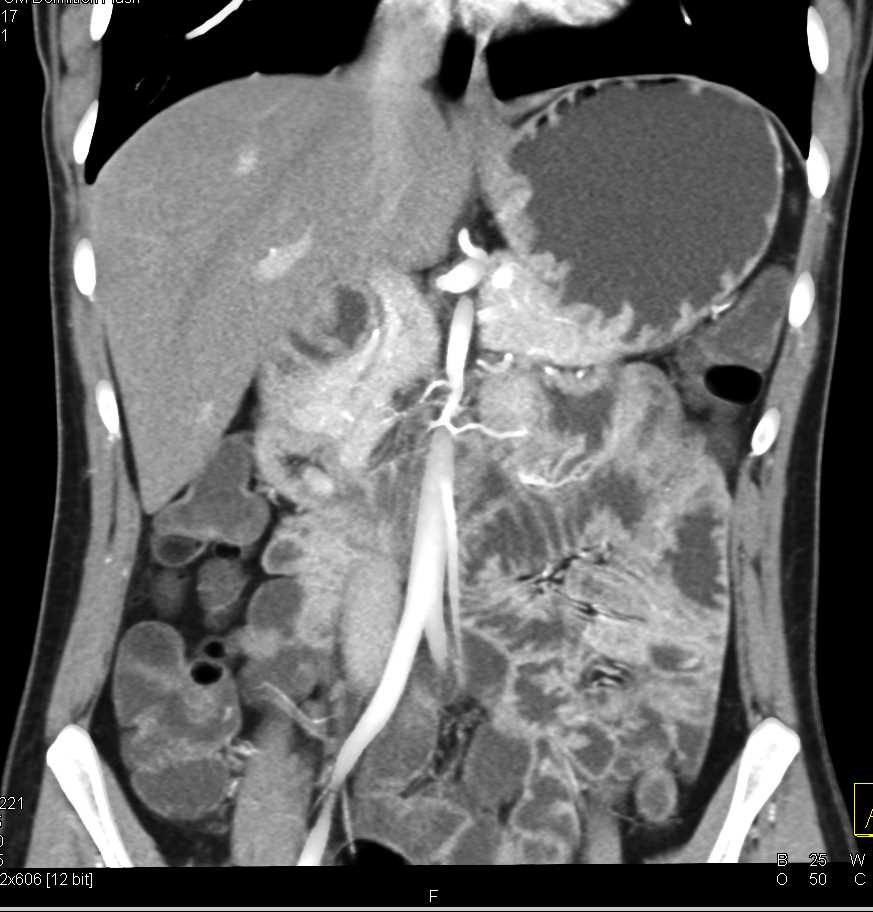 Gastritis - CTisus CT Scan