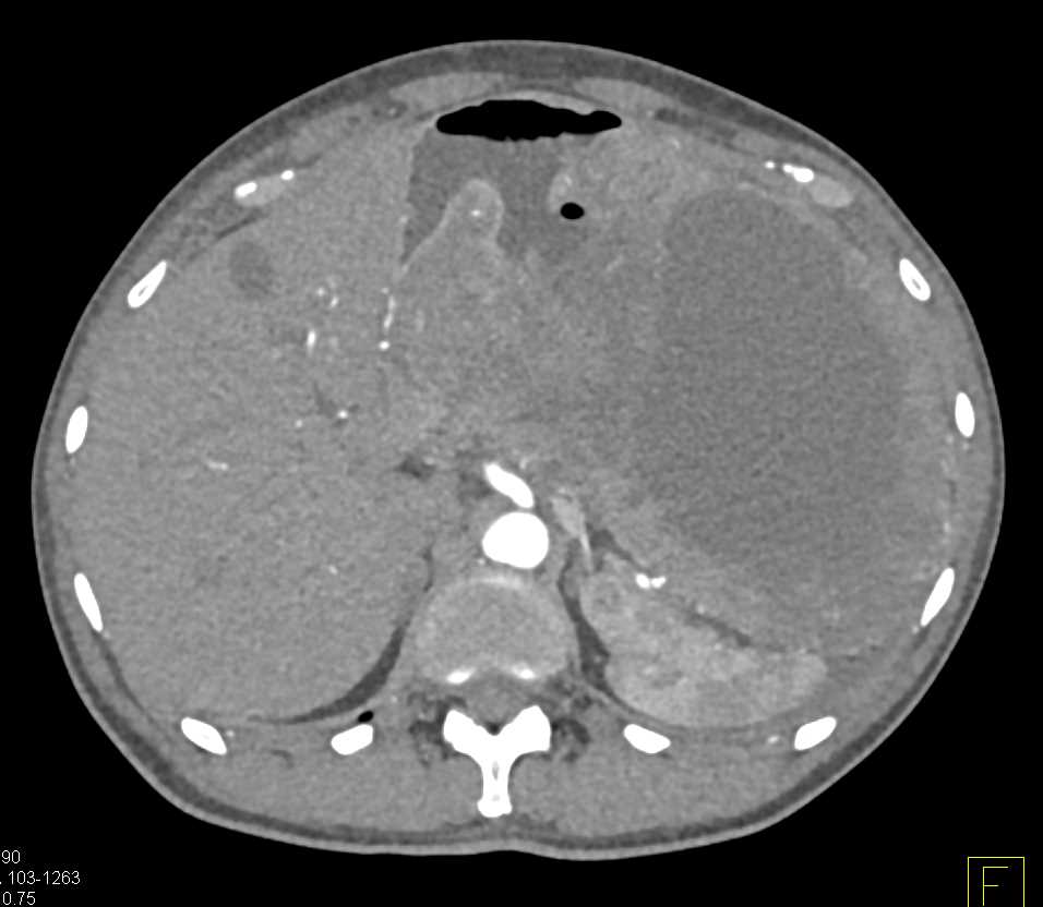 Ulcerating Gastric GIST Tumor - CTisus CT Scan