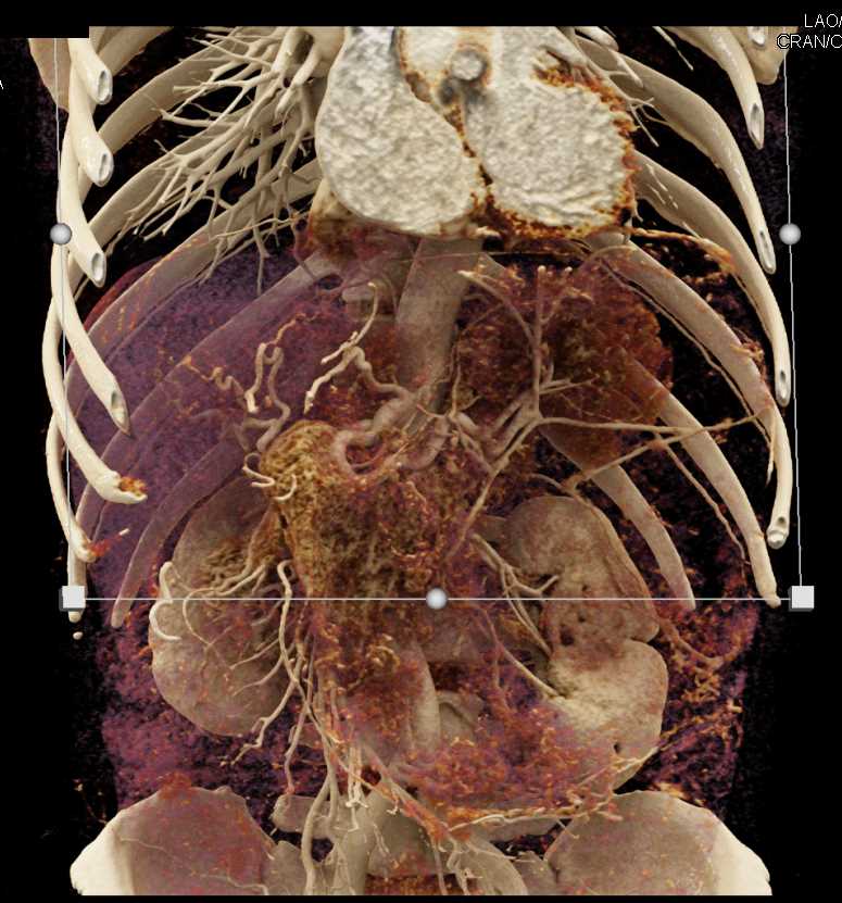 Ulcerating Gastric GIST Tumor - CTisus CT Scan