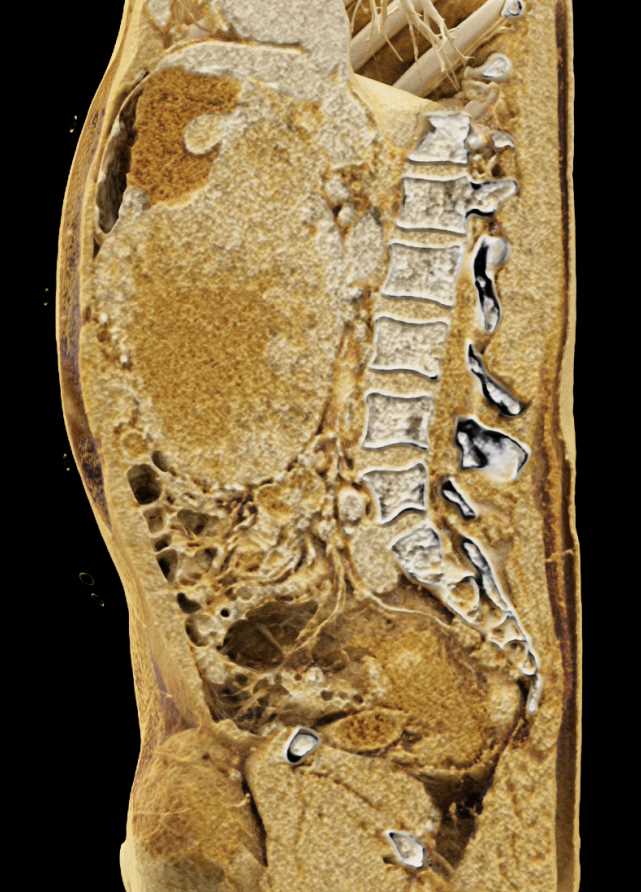 Ulcerating Gastric GIST Tumor - CTisus CT Scan