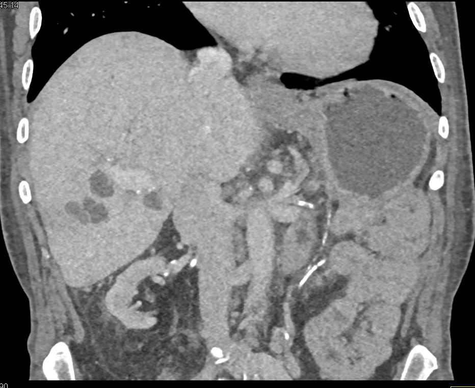 Gastric Adenocarcinoma and Liver Abscesses - CTisus CT Scan