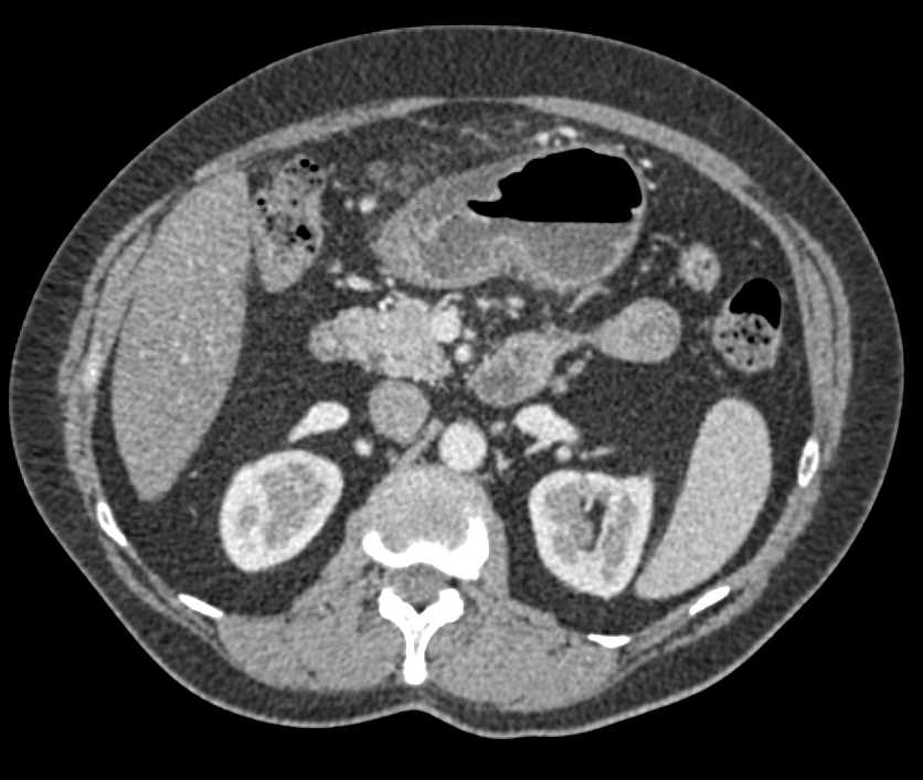 Infiltrating Adenocarcinoma Gastic Antrum - CTisus CT Scan