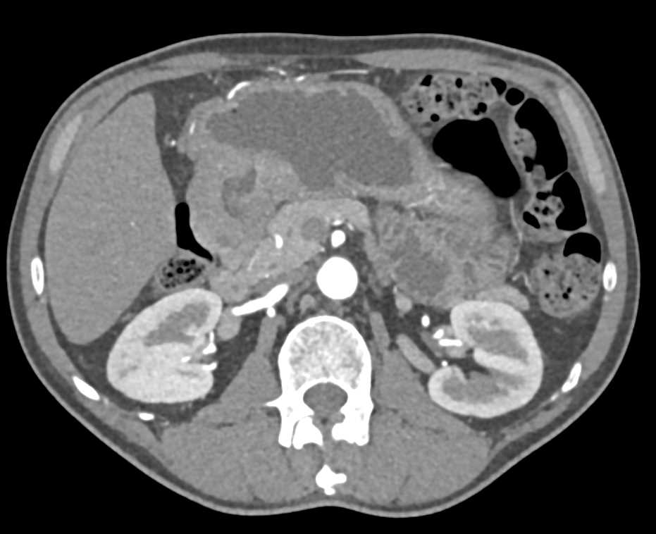 Adenocarcinoma Gastric Antrum - CTisus CT Scan