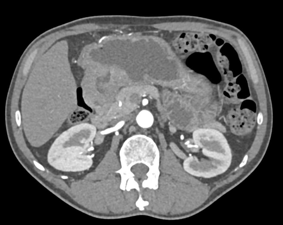 Adenocarcinoma Gastric Antrum - CTisus CT Scan