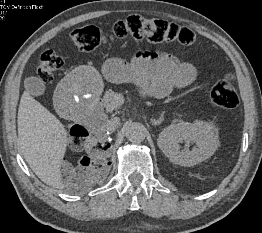 Pills in the Stomach - CTisus CT Scan