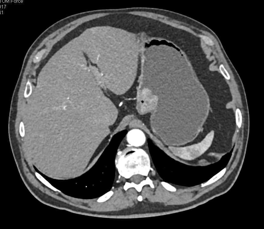 Gastric GIST Tumor - CTisus CT Scan