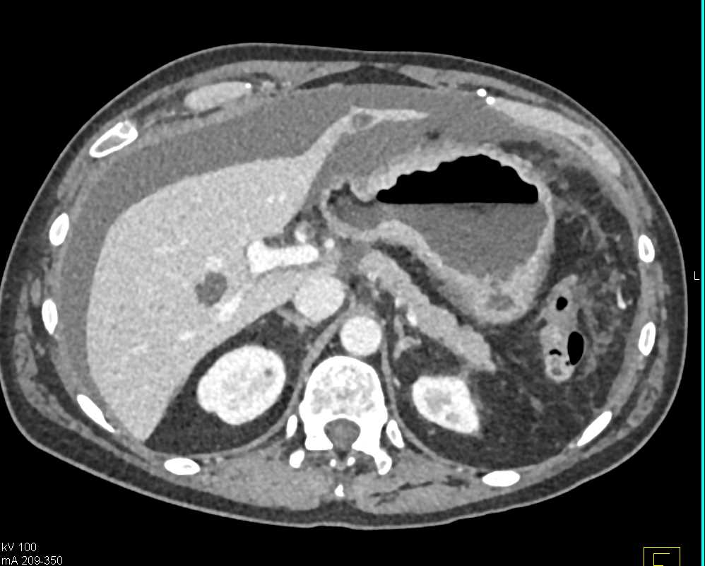 Gastric Cancer with Carcinomatosis - CTisus CT Scan