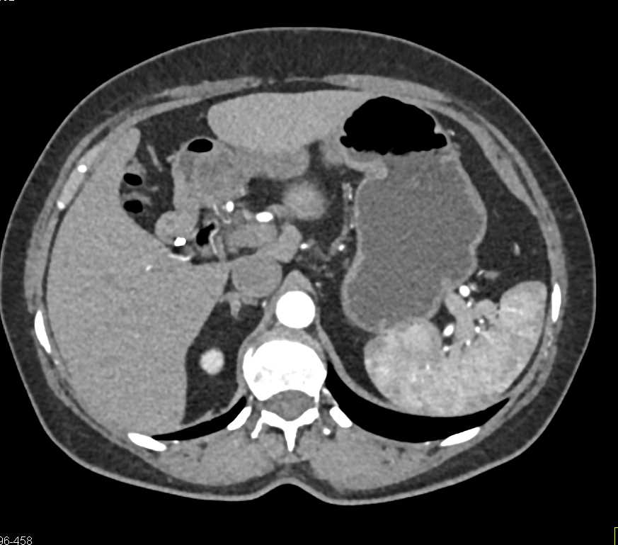 Leiomyoma in the Gastric Antrum - CTisus CT Scan