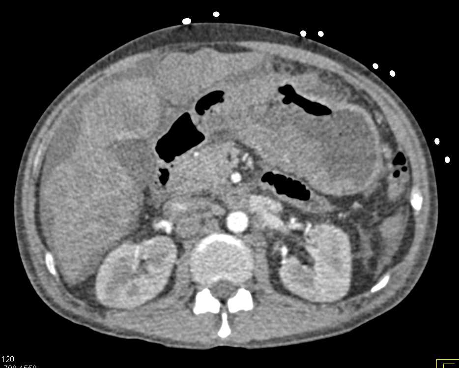 Gastric Cancer with Liver Metastases - CTisus CT Scan