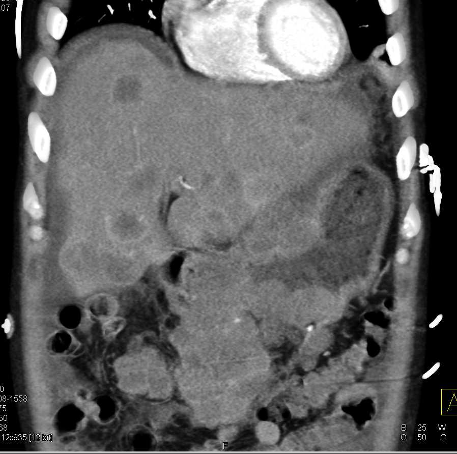 Gastric Cancer with Liver Metastases - CTisus CT Scan