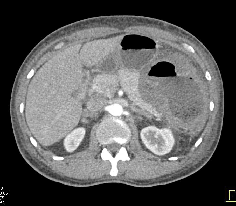 LUQ Abscess - CTisus CT Scan