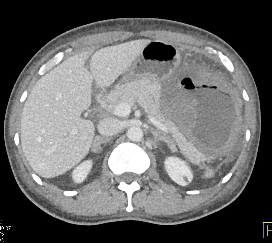 LUQ Abscess due to Perforated GIST Tumor - CTisus CT Scan