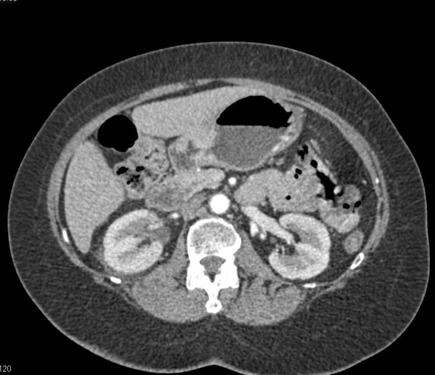 Carcinoma of the Gastric Antrum - CTisus CT Scan