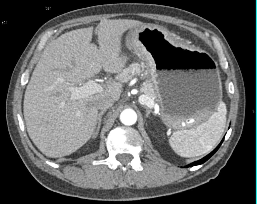 Infiltrating Gastric Adenocarcinoma - CTisus CT Scan