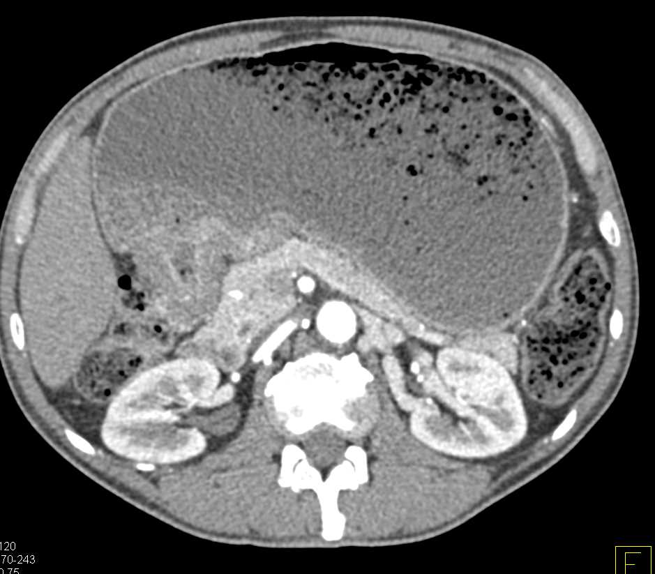 Gastric Antral Cancer Causes Gastric Outlet Syndrome - CTisus CT Scan