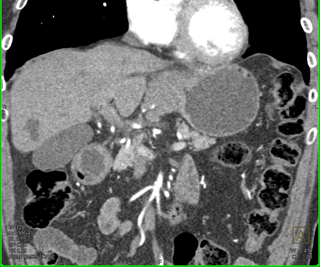 Gastric Adenocarcinoma with Para-Cardiac Nodes - CTisus CT Scan